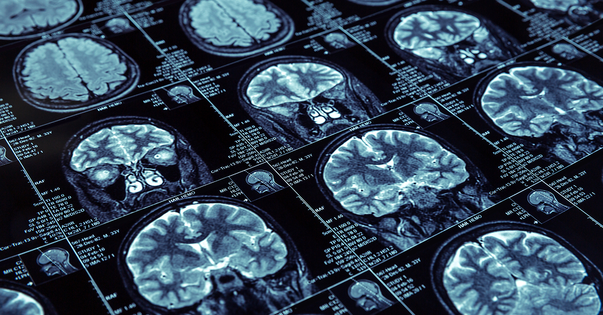 Por Que A Comunidade Científica Está Debatendo Tudo O Que Se Sabe Sobre O Alzheimer